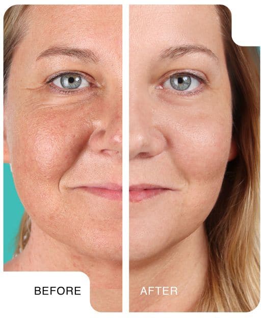 before and after skincare